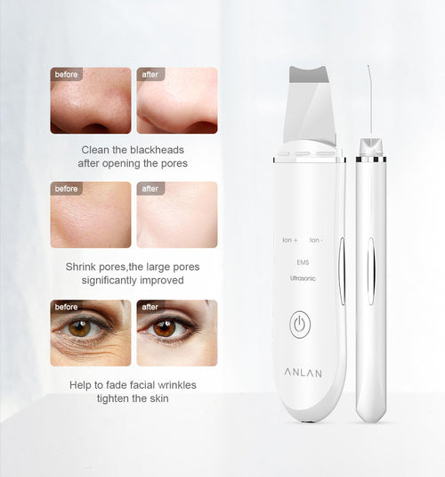 Ultrasonic Skin Scrubber Deep Face Cleaning & Pore Lift Machine